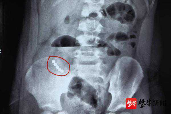 男童吞下5颗磁力珠，肠道磨穿4个洞